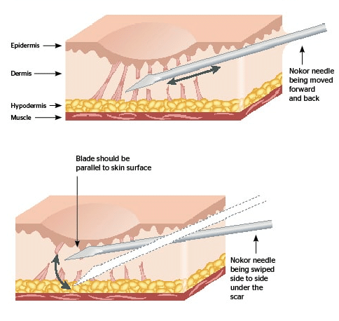 Subcision