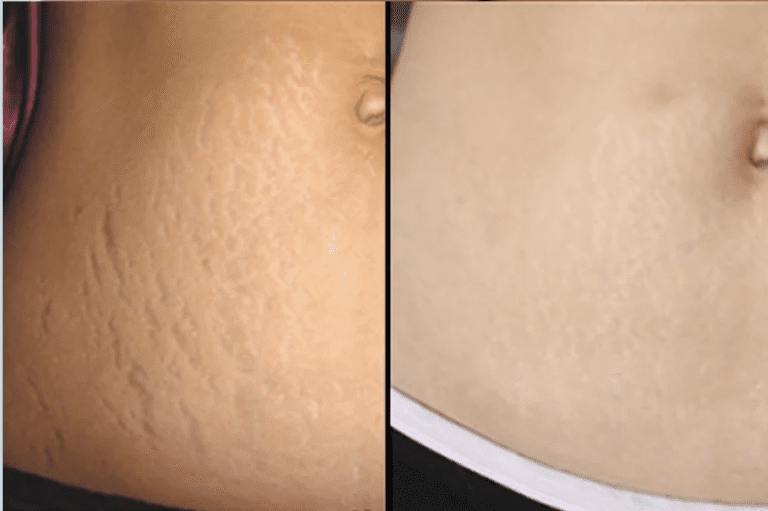 stretch mark removal with Morpheus8 in belly before after 768x511 1