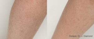 diolazexl-before-after-dr-j-diamond-preview-1